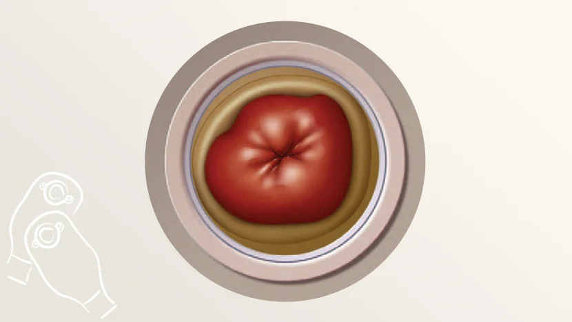 a cartoon drawing of a stoma